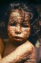 157px-Child_with_Smallpox_Bangladesh.jpg